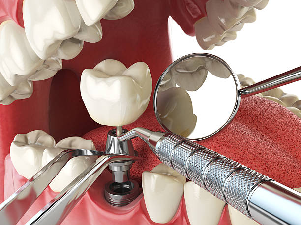 Best Emergency Dental Care for Broken or Chipped Teeth in Santa Ynez, CA